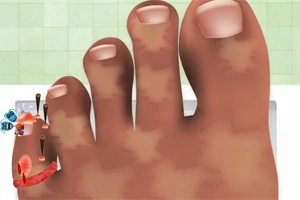Hình ảnh mô tả một bàn chân với ngón chân cái bị nhiễm trùng và đầy đinh