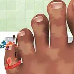Hình ảnh mô tả một bàn chân với ngón chân cái bị nhiễm trùng và đầy đinh